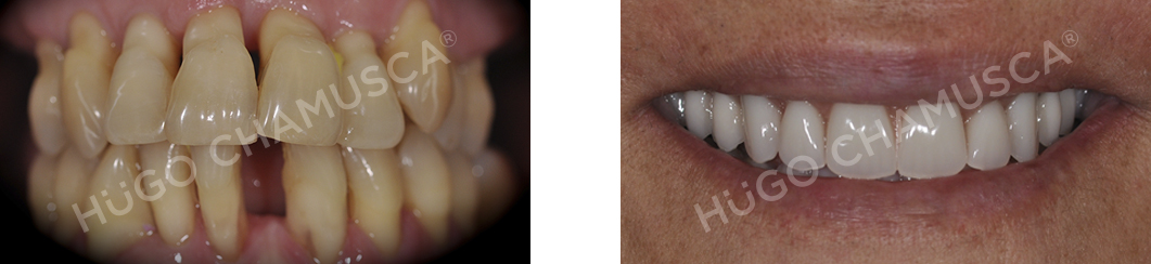 full rehabilitation over implants
