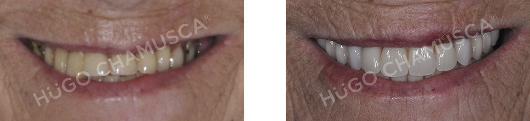 full rehabilitation over implants