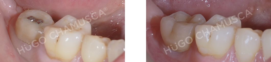 single implant