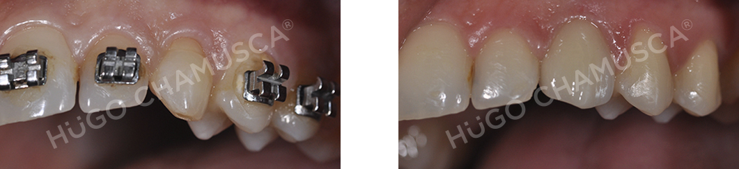 single implant