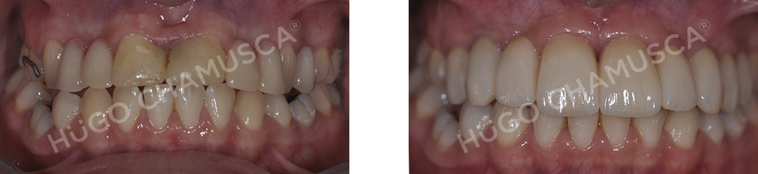 bridge over implants
