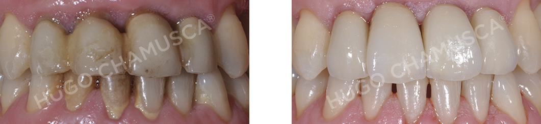 bridge over implants