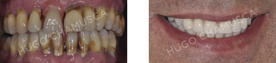 full rehabilitation over implants