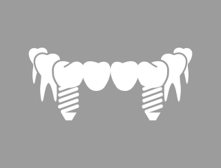 BRIDGE OVER IMPLANTS