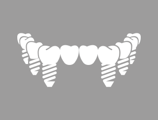TOTAL REHABILITATION OVER IMPLANTS WITHOUT ARTIFICIAL GUM