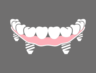 TOTAL REHABILITATION OVER IMPLANTS WITH ARTIFICIAL GUM